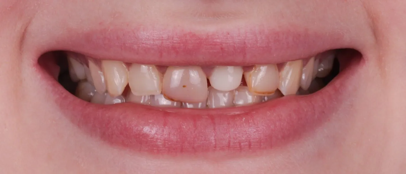 Эстетическая реабилитация: Установка керамических виниров — до лечения